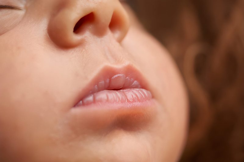 Understanding Cleft Lip in Children: Causes, Treatments, and Support