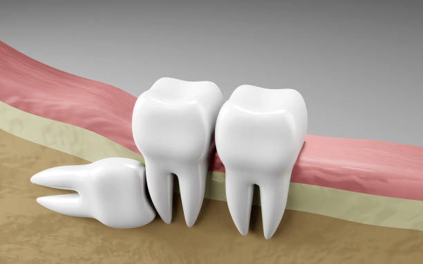 The Difference Between Impacted and Fully Erupted Wisdom Teeth