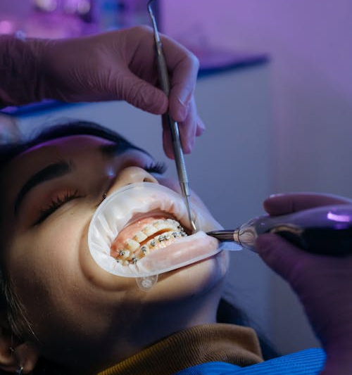 Starting Invisalign Treatment